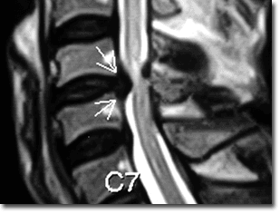 Les maux de tête aux problèmes dans le service cervical